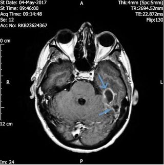 A man developed a severe infection in his ear canal from a cotton swab that spread to the lining of his brain. Above, an MRI of the man's head showing two abscesses in the lining of the man's brain.