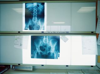 An X-ray held up so it can be examined