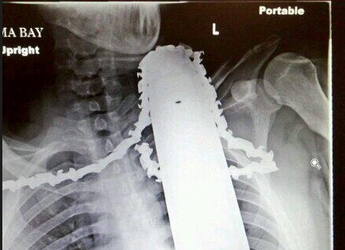 Man 'lucky' to survive a chainsaw slicing through his neck and shoulder