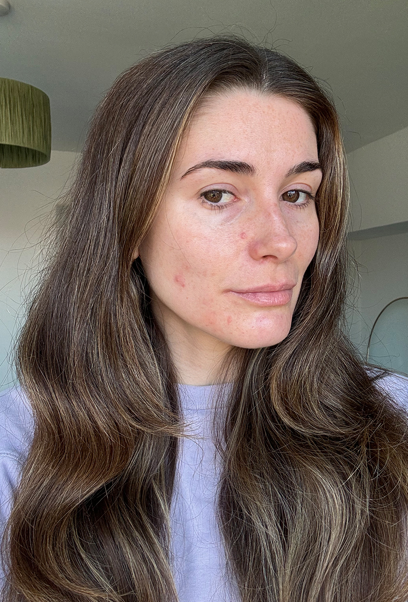 Eleanor before using Beauty Pie LED Mask