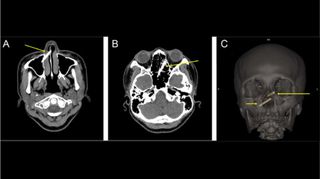 A CT scan showing chopstick fragments penetrating the woman's sinuses (A,B). A 3D reconstruction of the woman's skull showing the positions of the chopstick pieces (C).