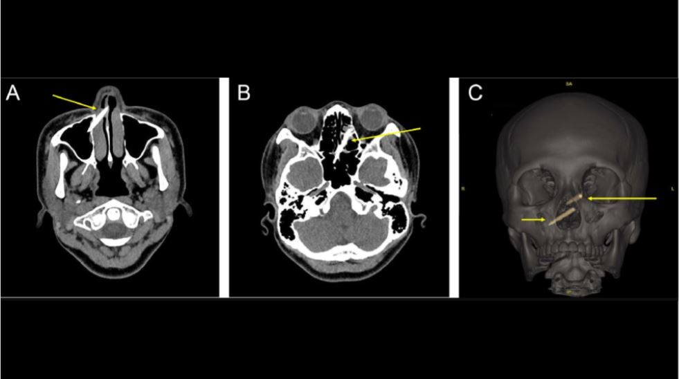 A CT scan showing chopstick fragments penetrating the woman&#039;s sinuses (A,B). A 3D reconstruction of the woman&#039;s skull showing the positions of the chopstick pieces (C).