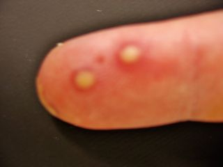 The man had small blisters on his infected little finger.