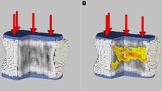 Two pixelated scans of a person's vertebra bone show a before image on the left and after image on the left that indicates bone density loss