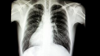 Black and white X-ray image of a person's chest. The heart is shown on the right-hand side of their chest.