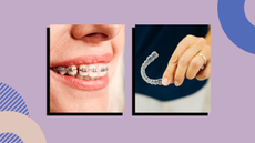 woman with braces and woman holding clear aligners on purple background 