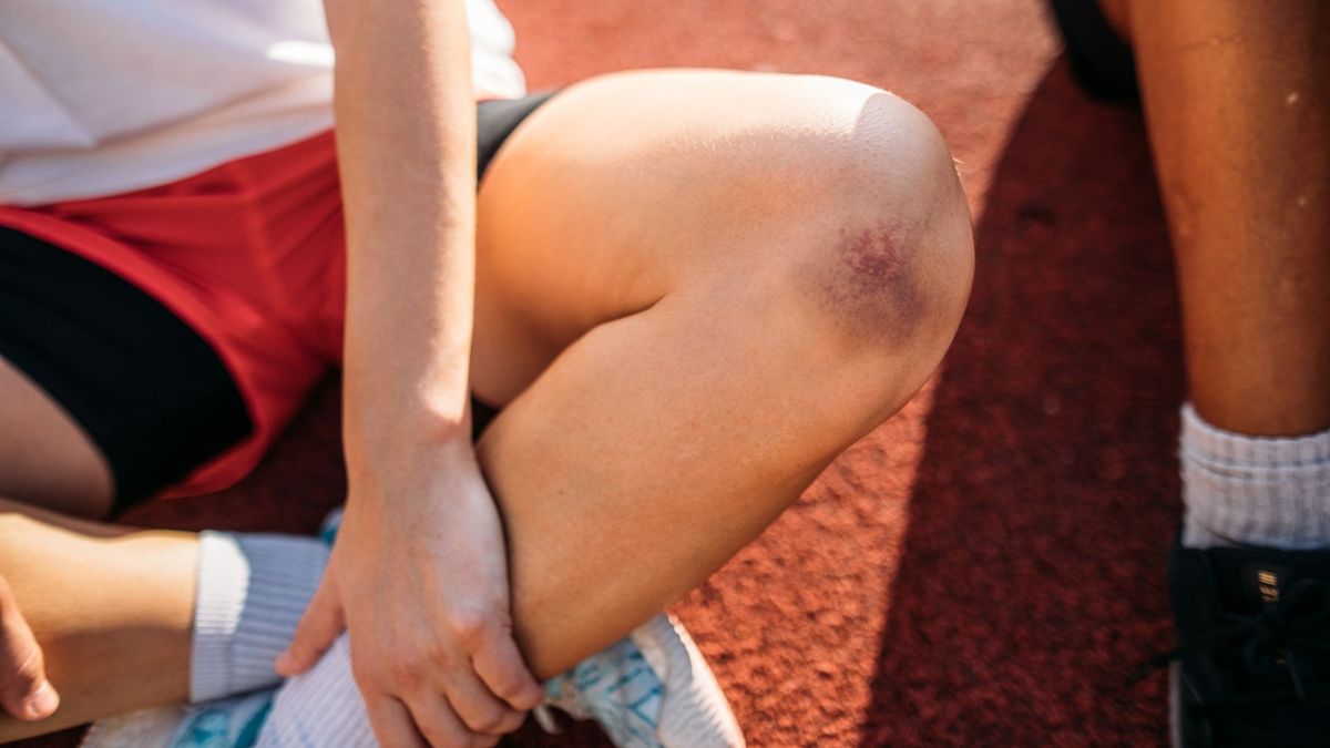 close up of a child&#039;s bruised knee as they sit cross-legged on a running track next to another child in athletic clothes