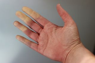 Raynaud's disease is more than just cold fingers and toes. The skin changes color because blood can't reach the area.