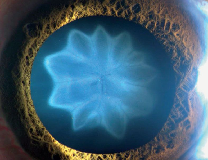 An image of a flower-shaped cataract in a man&#039;s eye.