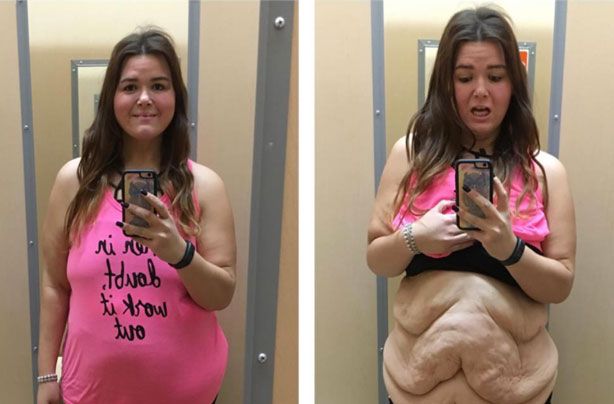 This Is My Life Woman Shares Reality Of Excess Skin After Incredible