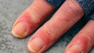 A close-up image of chilblains on a person's fingers.