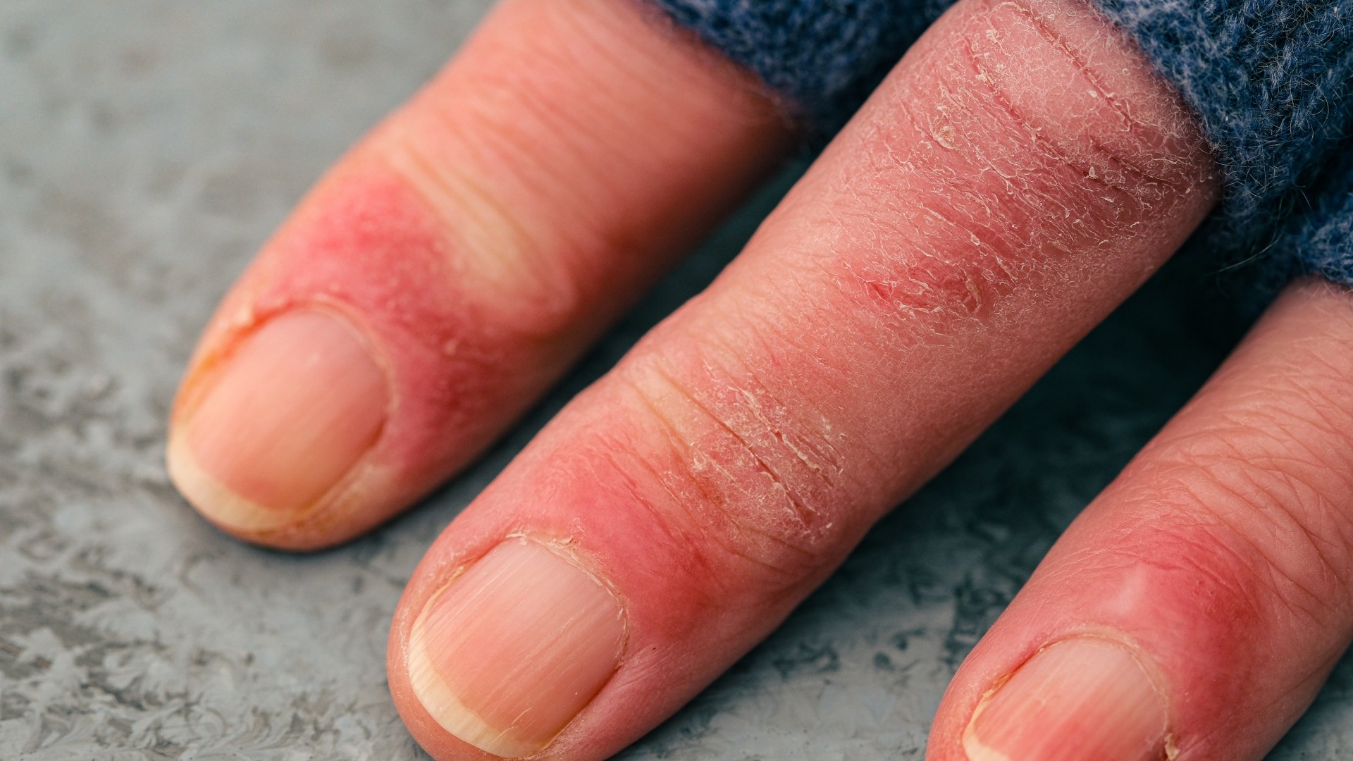 A close -up image of frights on a person's fingers.