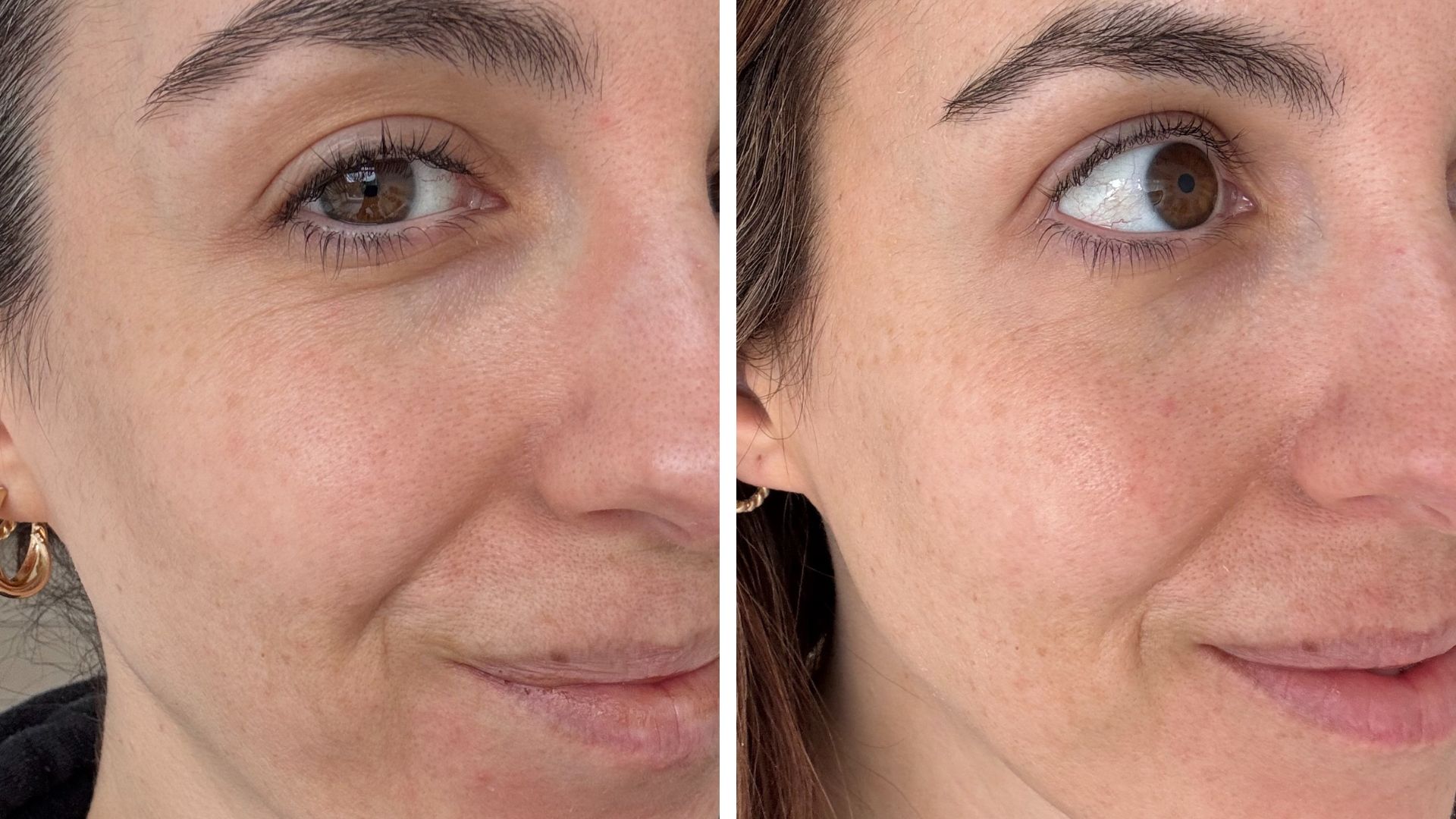 Before and after using the Lyma Laser for four months as part of our Lyma laser review