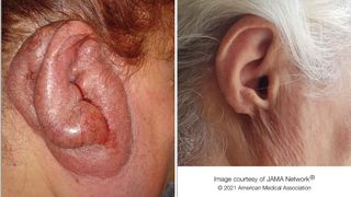 A woman in her 50s had a case of "turkey ear" (left) that had slowly progressed since her childhood. After treatment, the infection resolved, leaving a scar (right).