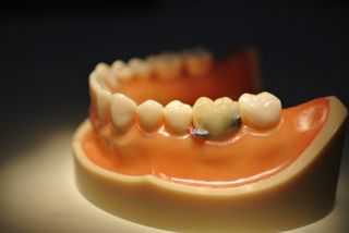 A smart tooth with wires attached to it sits within an artificial human jaw. 