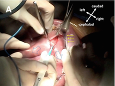 This image shows the fetus during the surgery.
