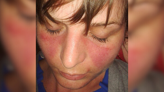 Close-up picture of a woman's face who has a "butterfly" skin rash on her face that is characteristic of the autoimmune disease lupus