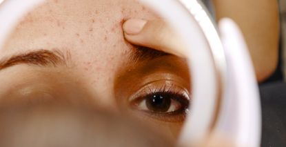 close up of woman looking at forehead acne in mirror