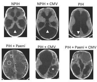 CT brain scans of infants with hydrocephalus show differences in the brains of those with post-infectious hydrocephalus (PIH), non-postinfectious hydrocephalus (NPIH), infection with the bacteria Paenibacillus (Paeni) or infection with the virus cytomegalovirus (CMV).