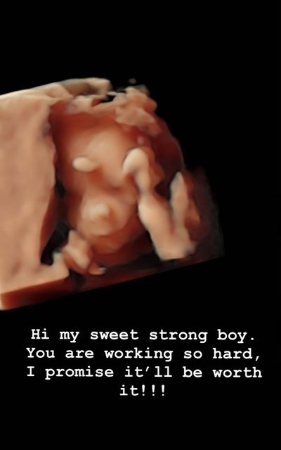 chrissy teigen ultrasound