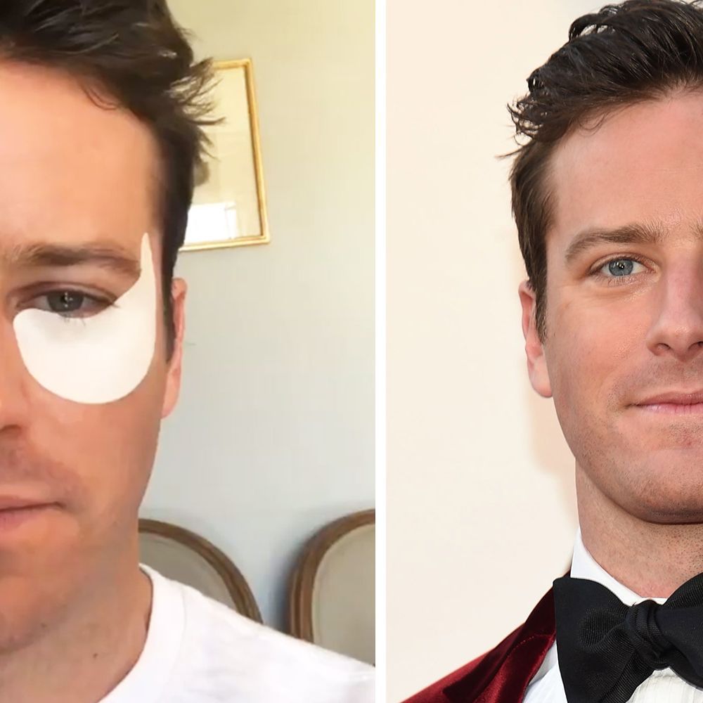 Armie Hammer Wore Eye Patches for the 2018 Oscars Armie Hammer Flu