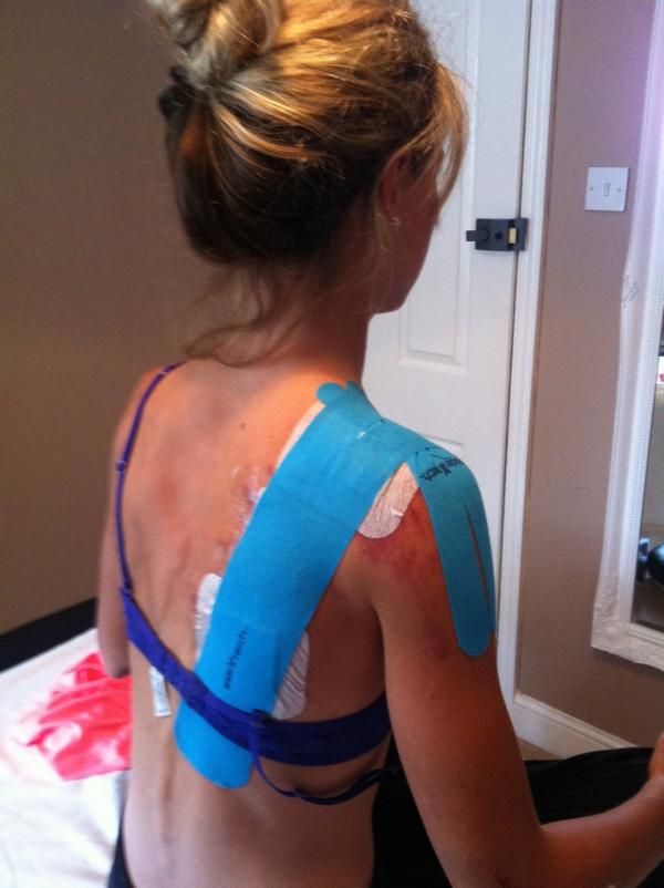 Emily Batty was all taped up after her bruises and broken collarbone.