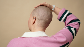 Back view of bald young woman touching head with no hair in studio. Alopecia and cancer survivor concept.