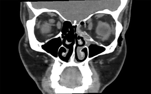 This Woman Broke A Bone In Her Eye Socket By Blowing Her Nose Too Hard Live Science This Woman Broke A Bone In Her Eye Socket By Blowing Her Nose Too Hard Live Science