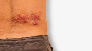 Close up of shingles outbreak on the lower back. Here we see a pattern of small, dark-colored blisters on a small section of the lower back.