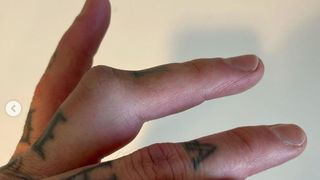 Travis Barker's mangled finger