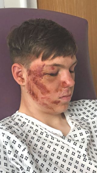 Tom Townsend with severely grazed face following the second accident