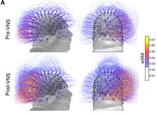 The patient's brain activity before (top) and after (bottom) the nerve-stimulation therapy.