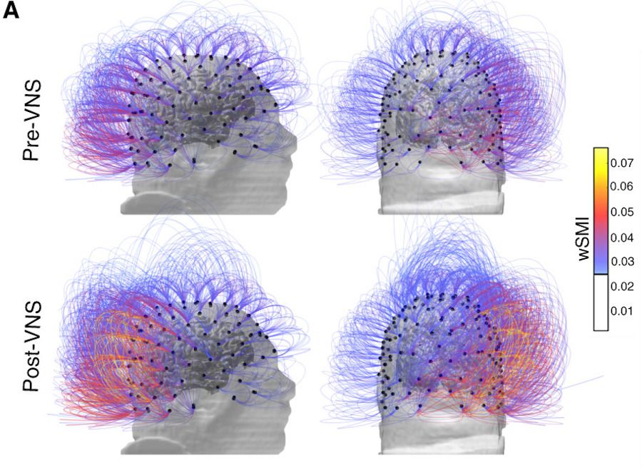 The patient&#039;s brain activity before (top) and after (bottom) the nerve-stimulation therapy.