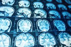 A brain MRI.