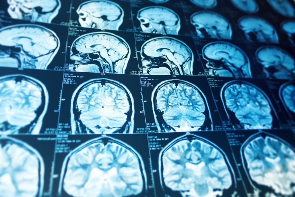 What is brain death? New guidelines offer answers.