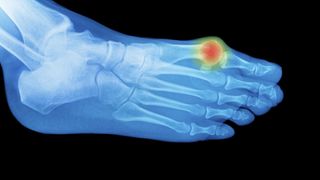 graphic of a bunion