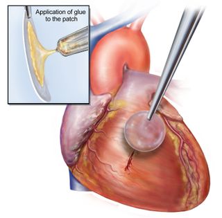 A new glue is used to patch a wound in a heart tissue.