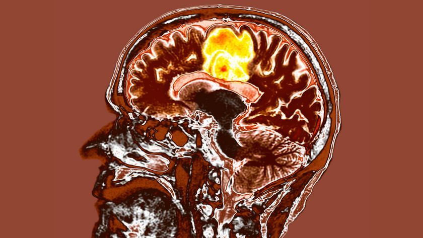 A CT scan of a head showing a glioblastoma