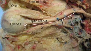 An image from a dissection shows a human optic nerve from a side-view of the face.