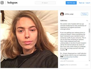 The model Anthea Page posted on Instagram that she contracted a staph infection of the eye after getting her makeup done at a fashion show.