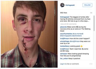 Chad Haga posted a photograph of himself on Instagram showing his facial injuries