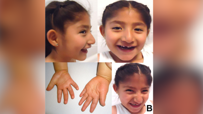 Composite image of four images of a young girl with Angelman syndrome. In two of the images she is facing she camera, in another she is side on to the camera and the other image shows her hands. Behind the composite image is a blurred, enlarged version if it.