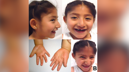 Composite image of four images of a young girl with Angelman syndrome. In two of the images she is facing she camera, in another she is side on to the camera and the other image shows her hands. Behind the composite image is a blurred, enlarged version if it. 