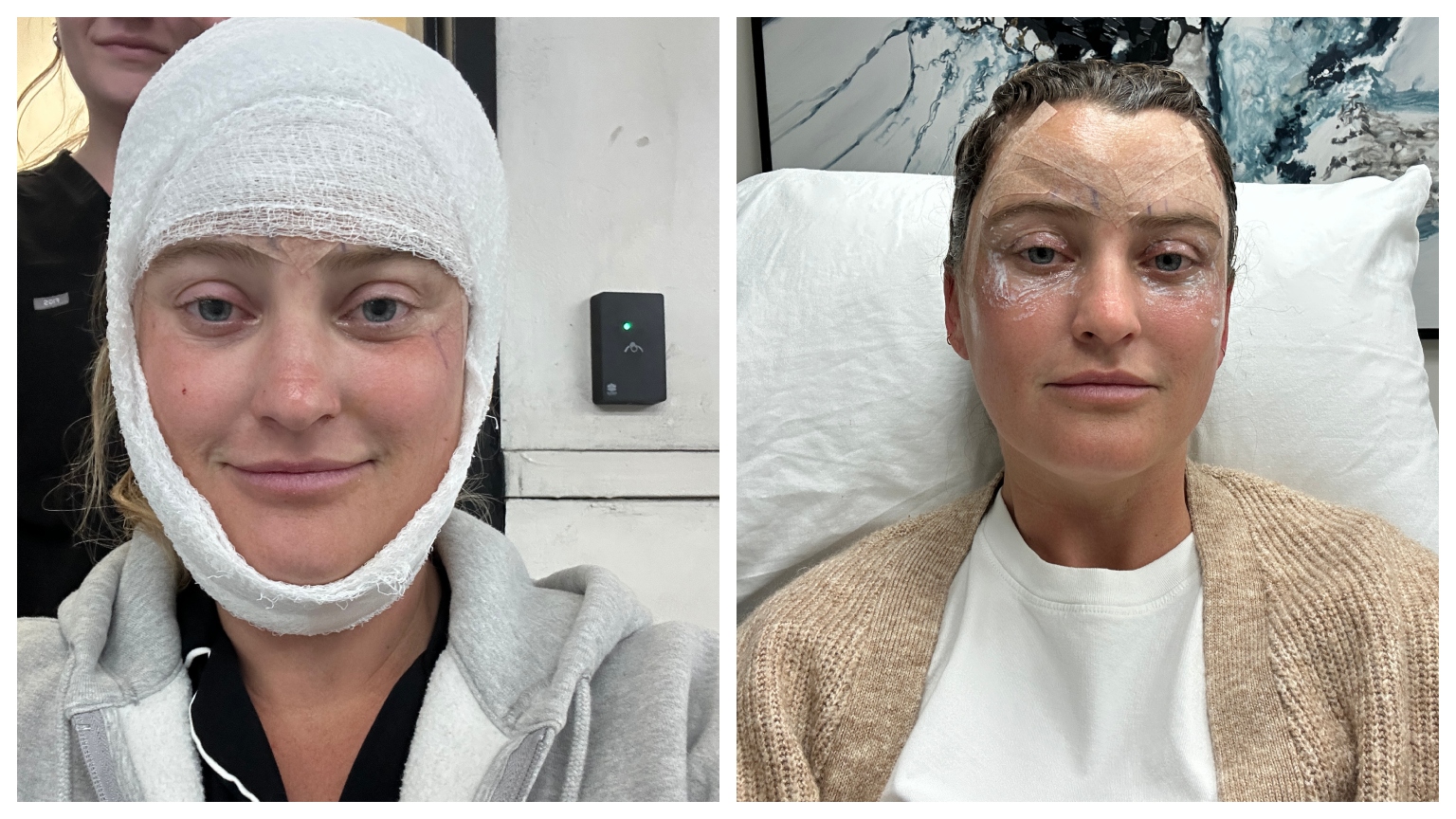 Aviel Kanter with her head wrapped in white gauze and another photo in a brown sweater with eye bruises after brow lift surgery
