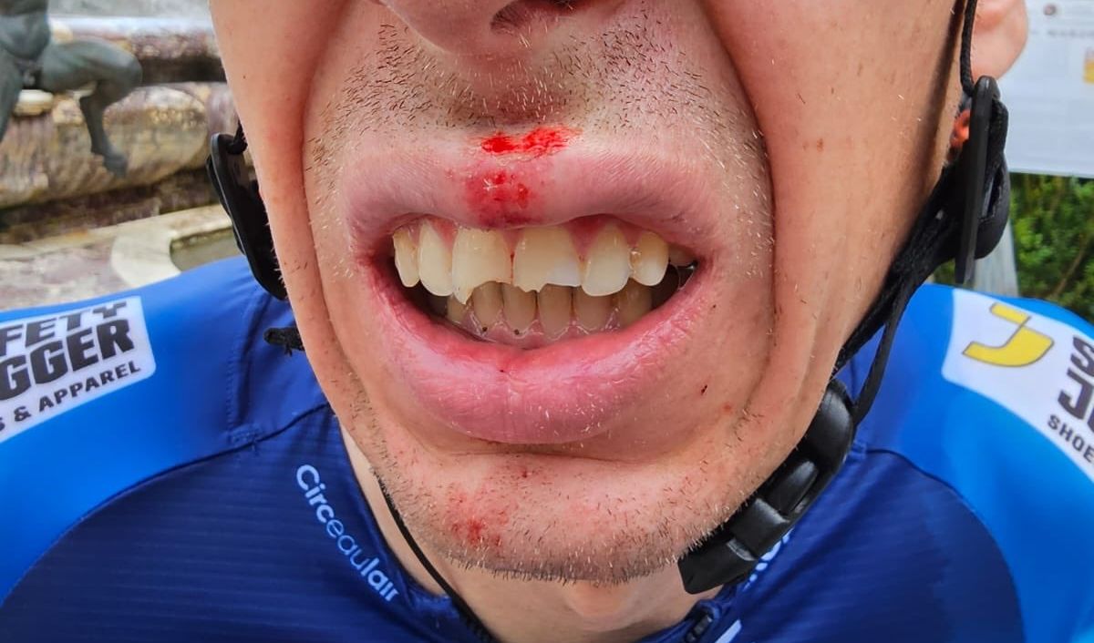 Jan Hirt&#039;s broken teeth