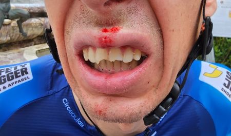 Jan Hirt's broken teeth