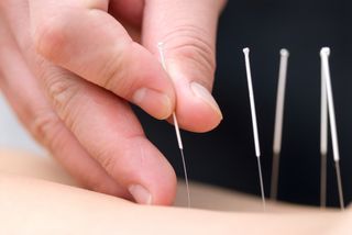 acupuncture