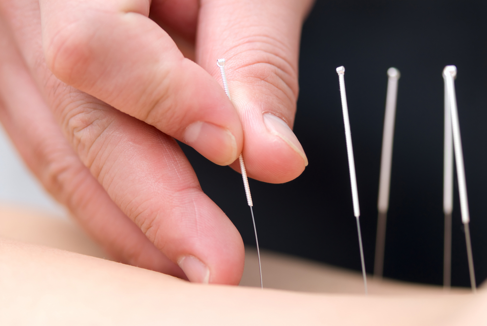 What is Acupuncture? | Does Acupuncture Work? | Live Science