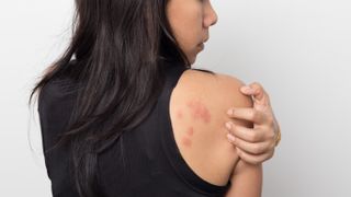 The skin rashes that may be tied to COVID-19 take many forms, from tiny red dots to larger, flat lesions, doctors say.