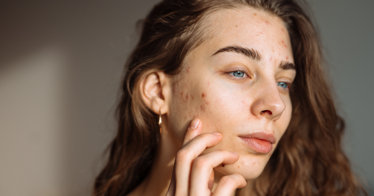 Death of skin positivity